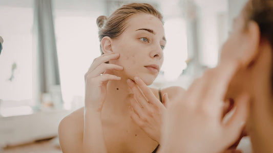 Kvinna som tittar på sin hud och akne i spegel innan microneedlingbehandling hemma.
